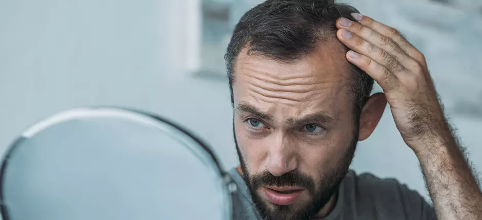 Alopecia: cuando la caída del cabello se convierte en problema